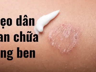 Mẹo dân gian chữa lang ben - Da sáng chỉ với 1 nguyên liệu